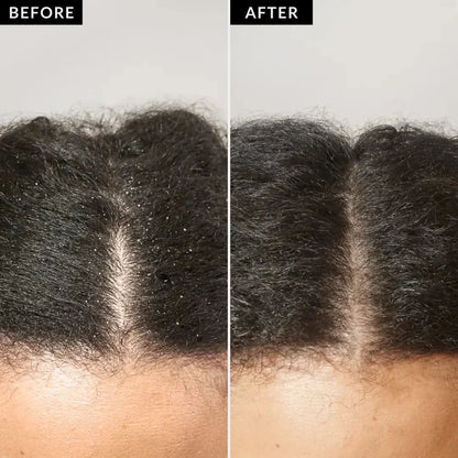 ClearScalp™ Detox Brush